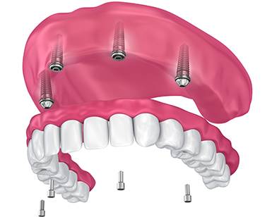 Dental Implant Denture