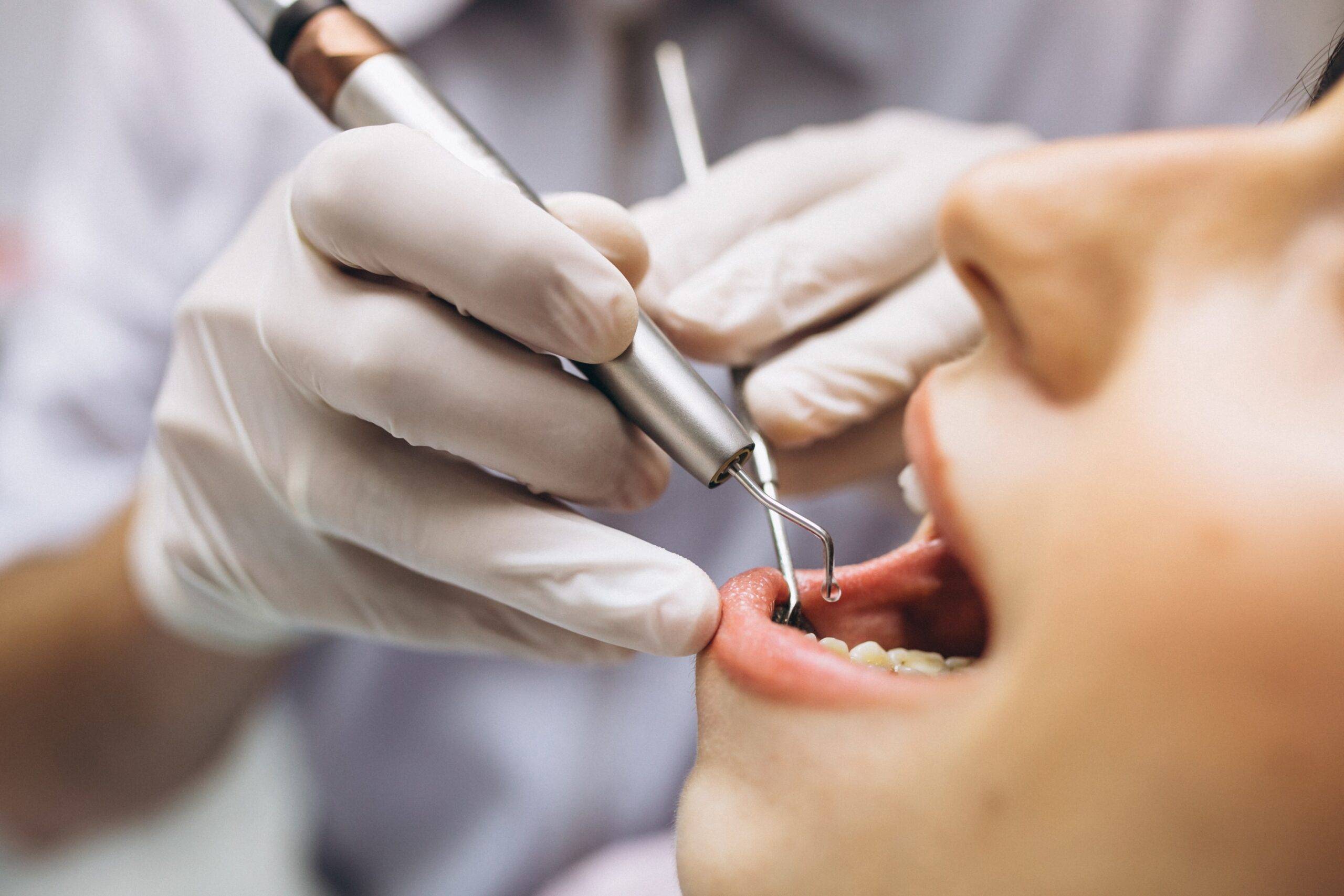 dental veneer procedure burke va