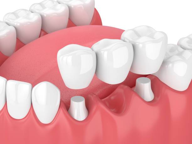 dental crowns in burke VA