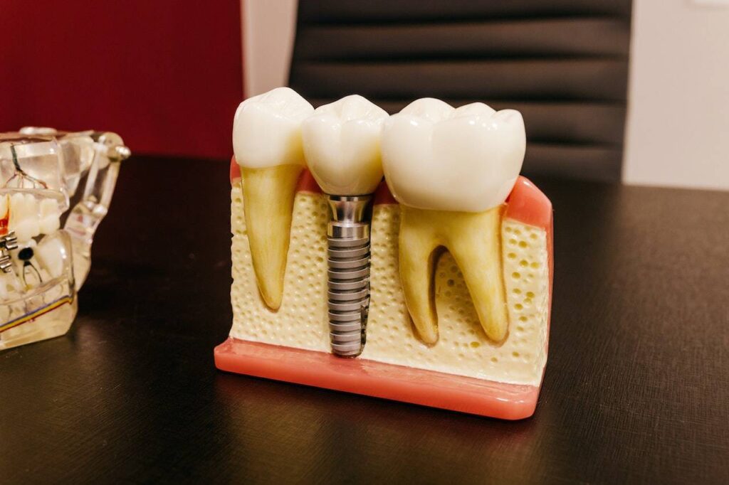 replace missing teeth at Shield Dental Care