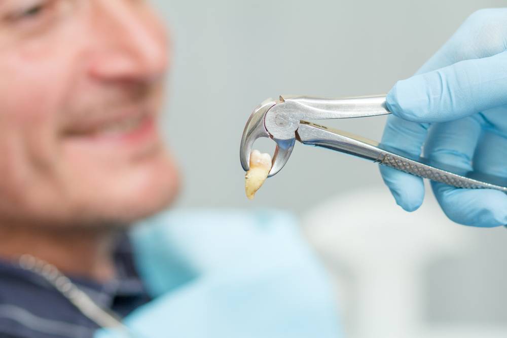 wisdom tooth extraction burke va