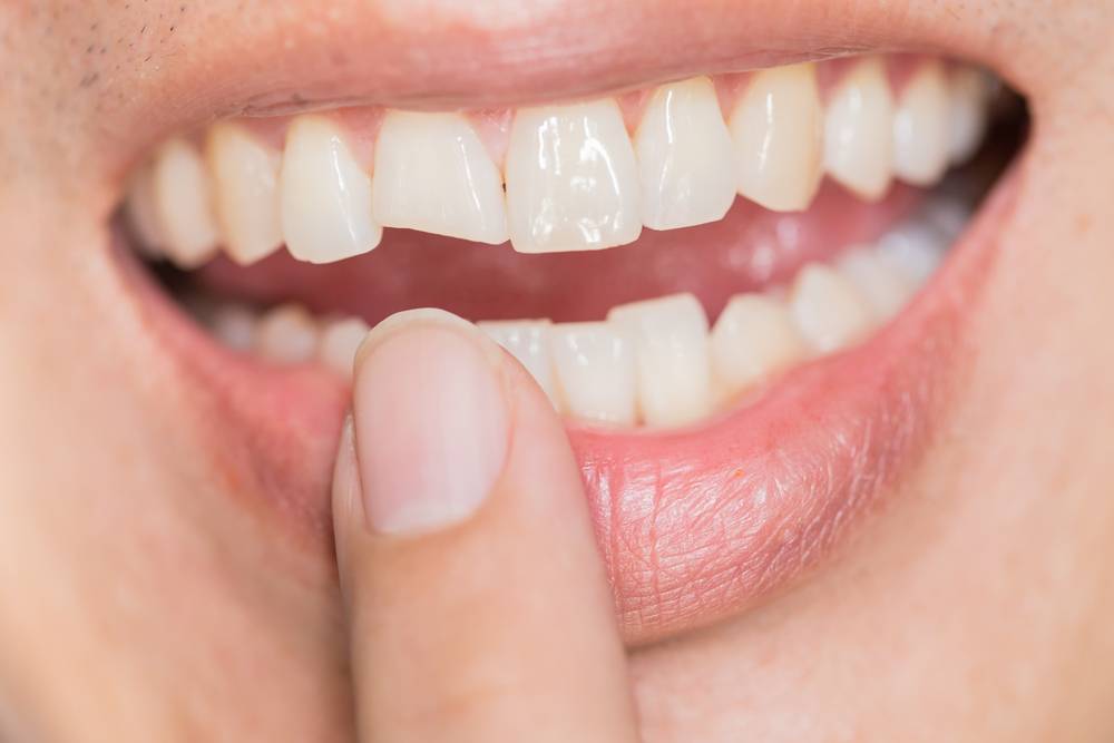 cracked tooth dental emergency burke va