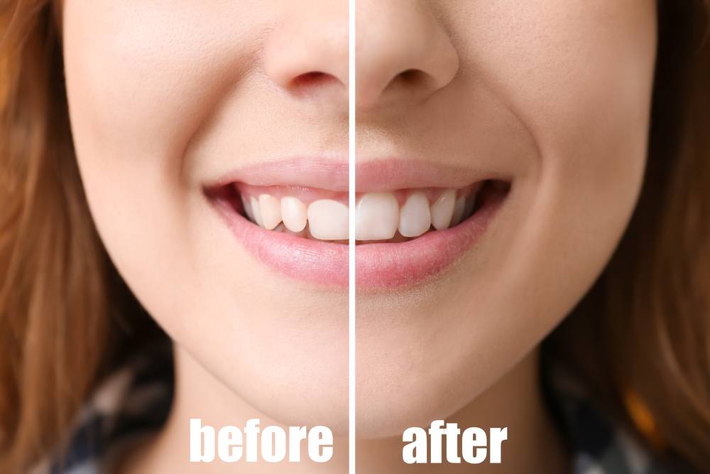 Periodontal Gum Surgery burke va