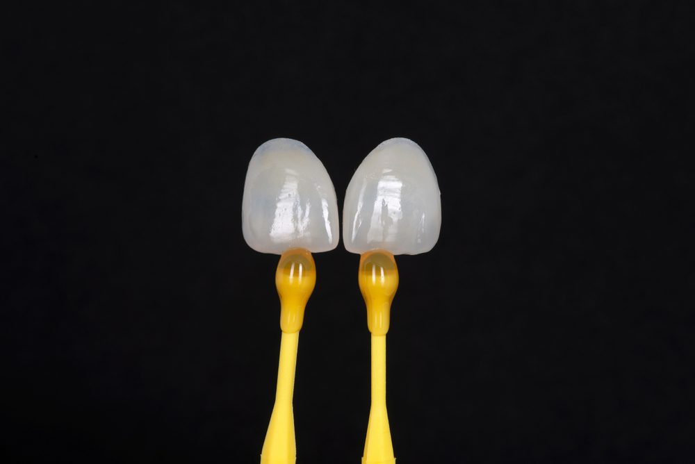 veneers burke va