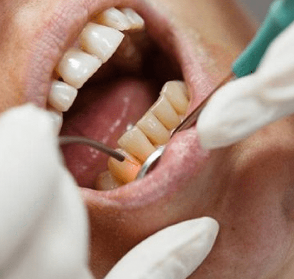 dental cleaning in burke va