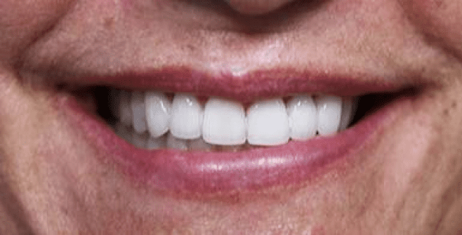 dental implants burke