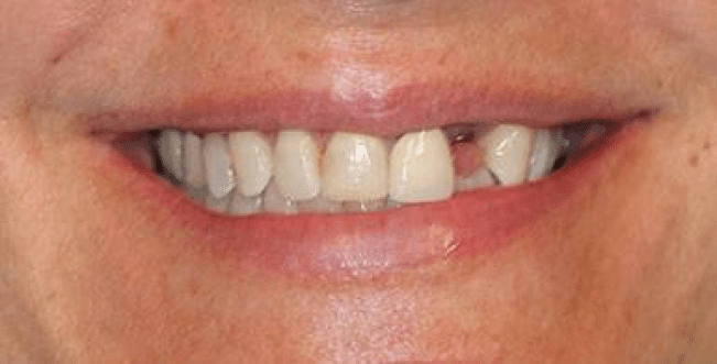 dental implants burke