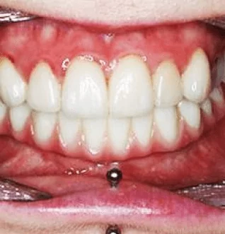 After: a full set of implant-supported teeth