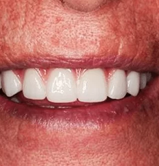 After: a fixed full arch of new teeth