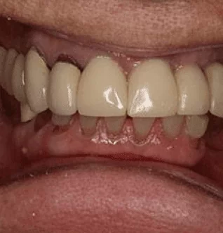 Before: failing upper teeth and receding gums