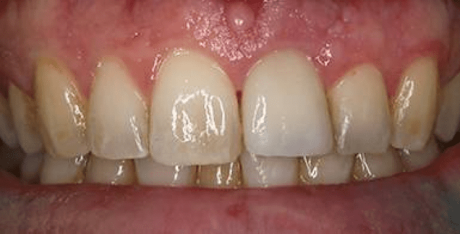 dental implants burke