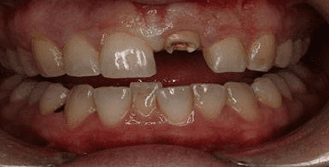 dental implants burke