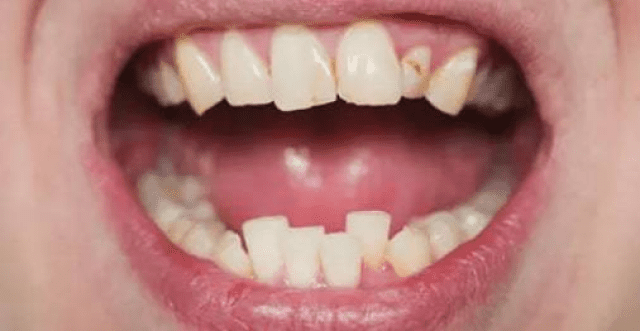 dental veneers burke va