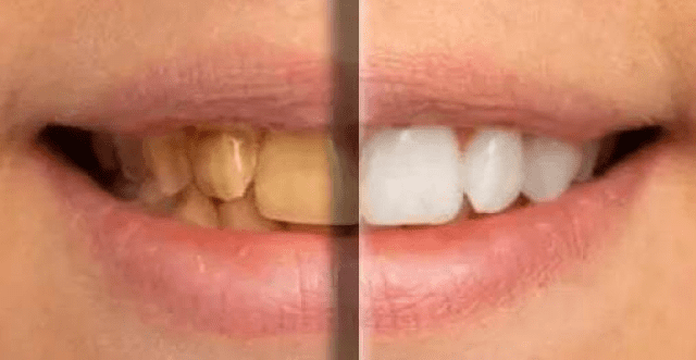 dental veneers burke va