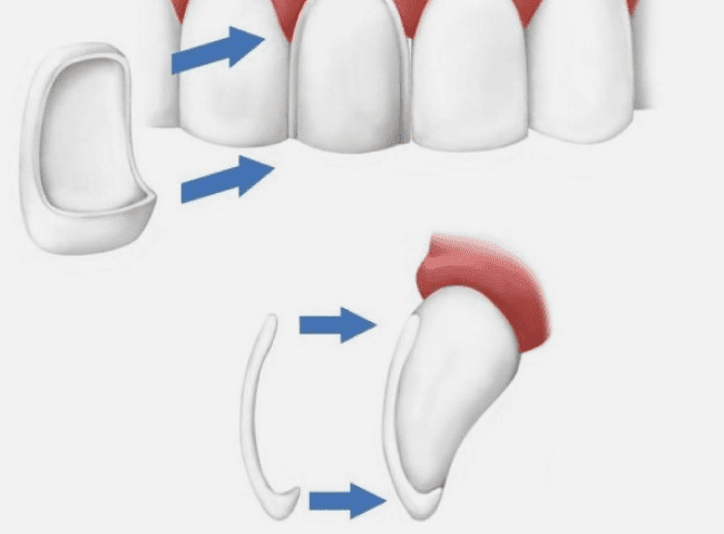 dental veneers burke va