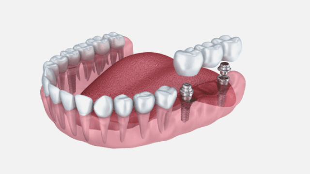 dental implants burke va