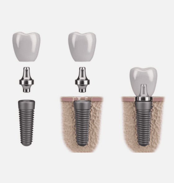 dental implants burke va