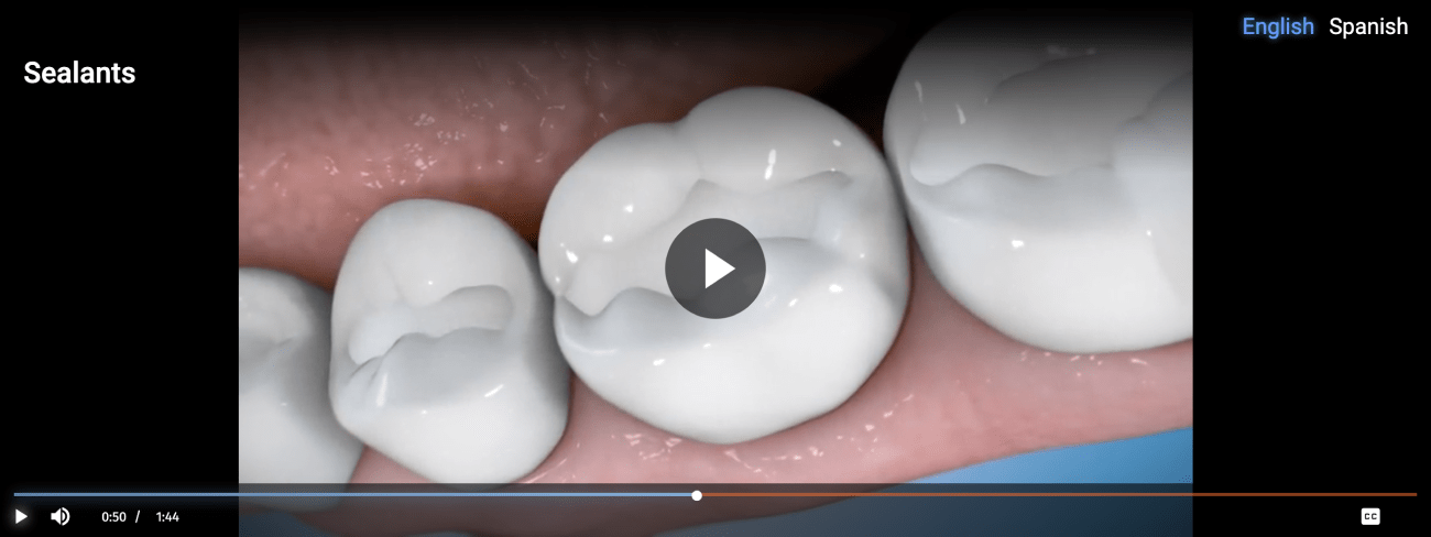 dental sealants burke va
