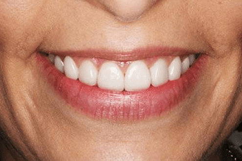 dental veneers burke va