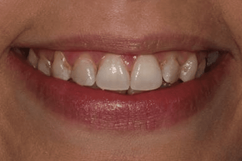 dental veneers burke va