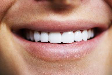 dental veneers burke va