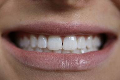 dental veneers burke va