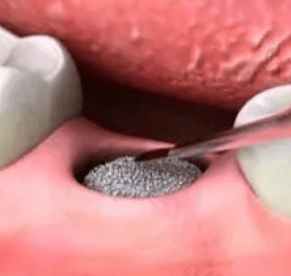 tooth extraction burke va