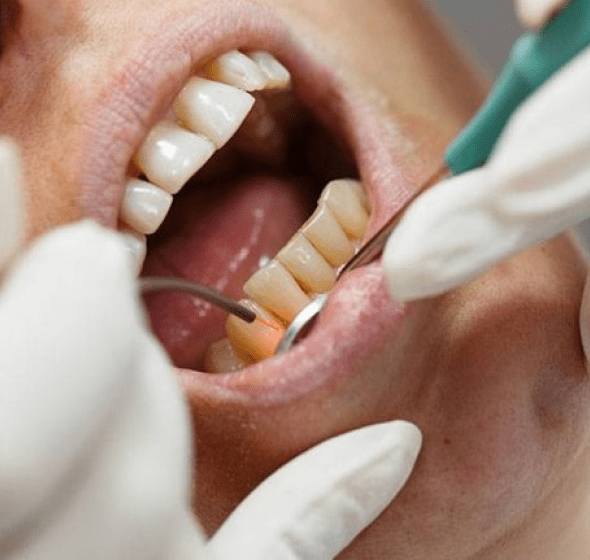 Periodontal Gum Surgery in Burke VA