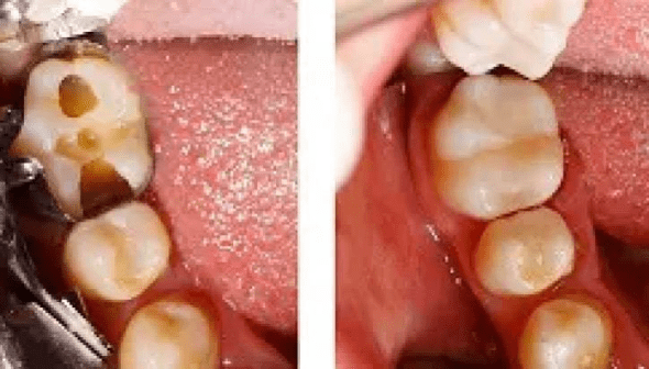 dental fillings in burke