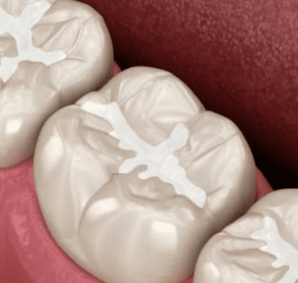 dental sealants in Burke, VA