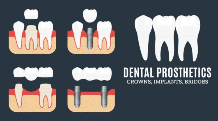 dental implant bridge burke va