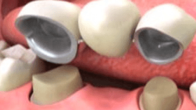 dental implants burke va