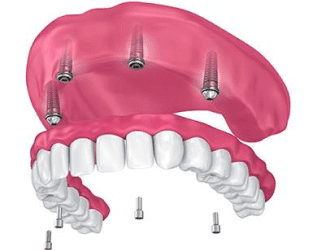 tooth repair burke va