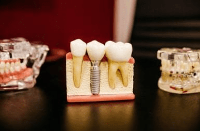 tooth repair burke va