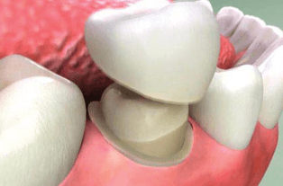 dental crowns and bridges in burke va
