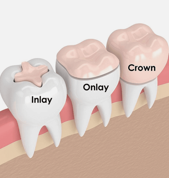 dental crown burke va