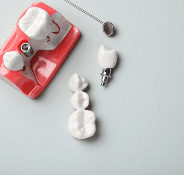 dental implants burke va