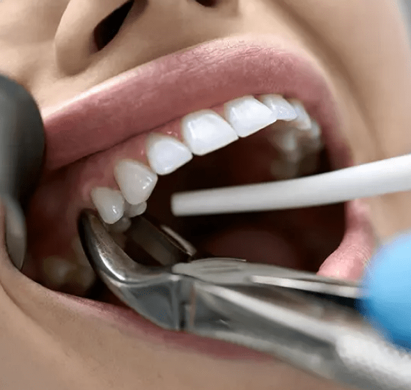 tooth extraction burke va