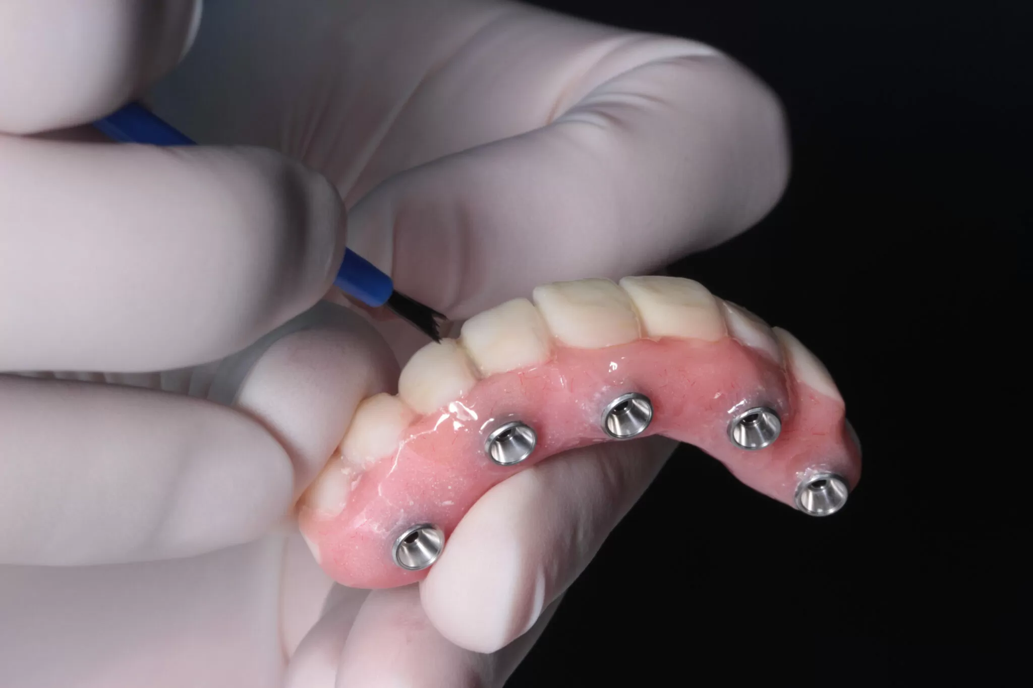 All-on-4 vs. Traditional Dental Implants