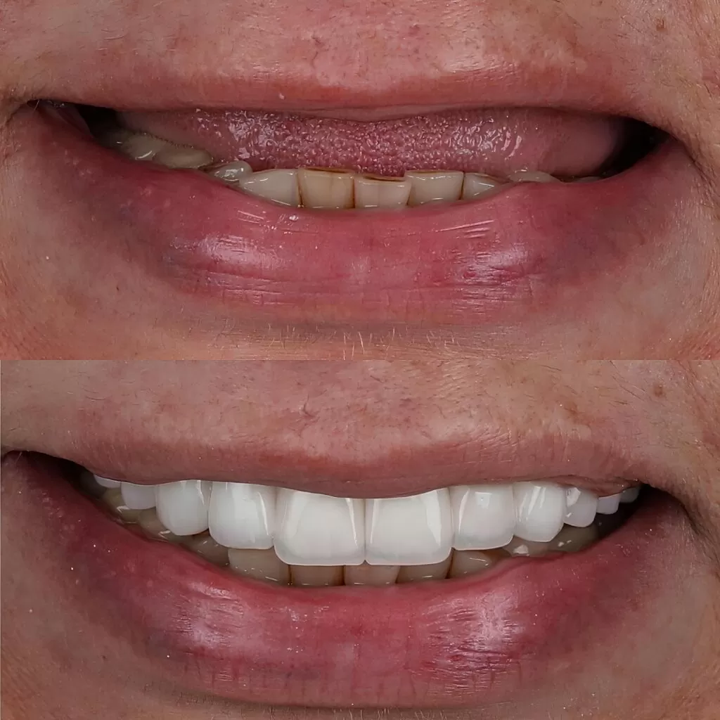 Who Is a Good Candidate for Dental Implants?