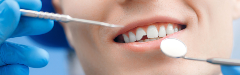 chipped or broken tooth