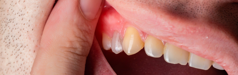 is a dental abscess an emergency?