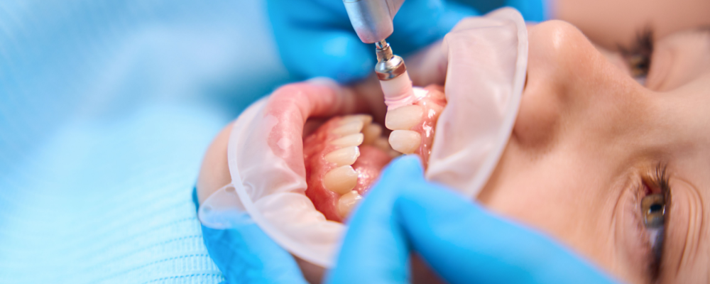 dental restoration