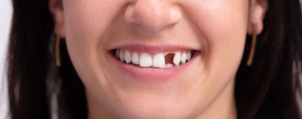 missing tooth