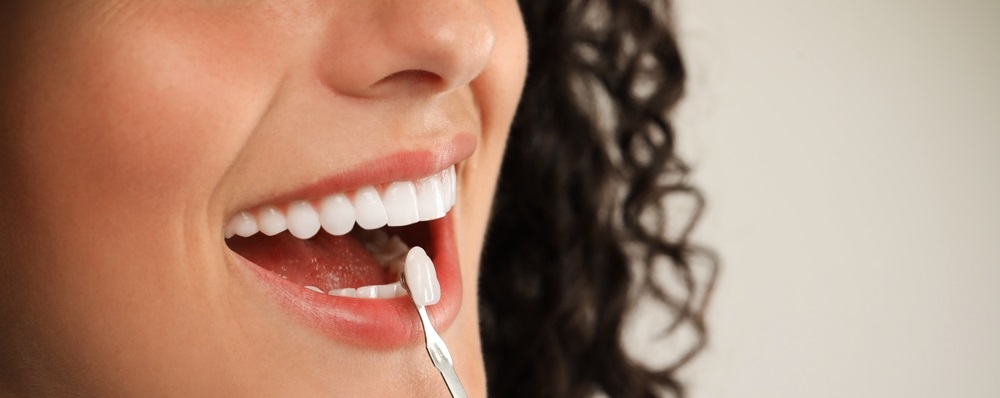 woman getting dental veneer