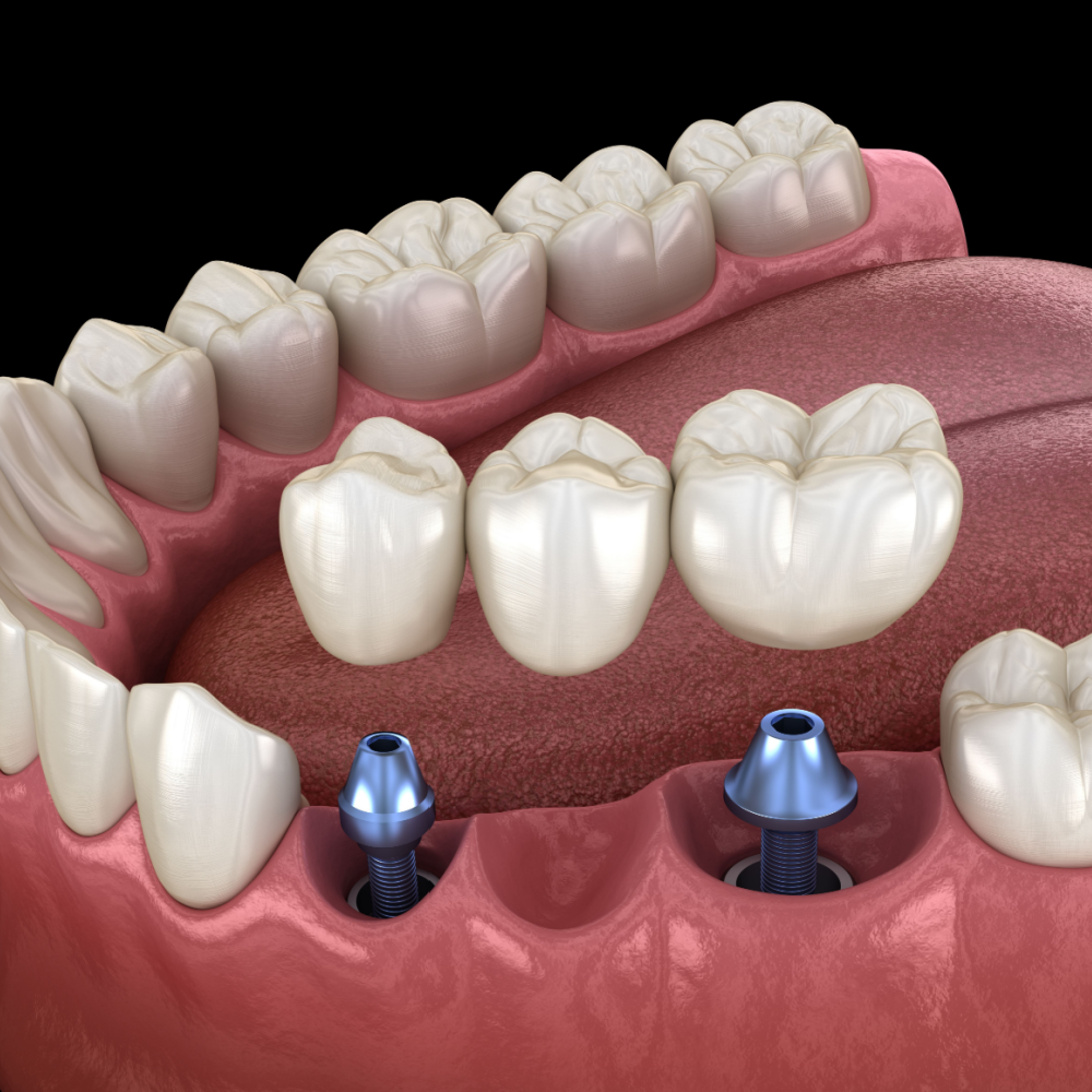 dental bridge in burke va