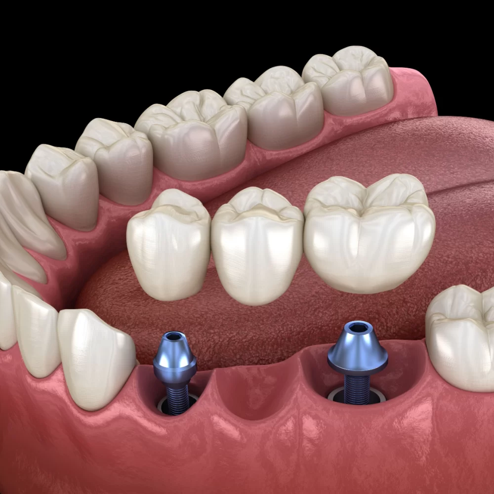 Combining Veneers, Implants, and Bridges for a Full Dental Restoration