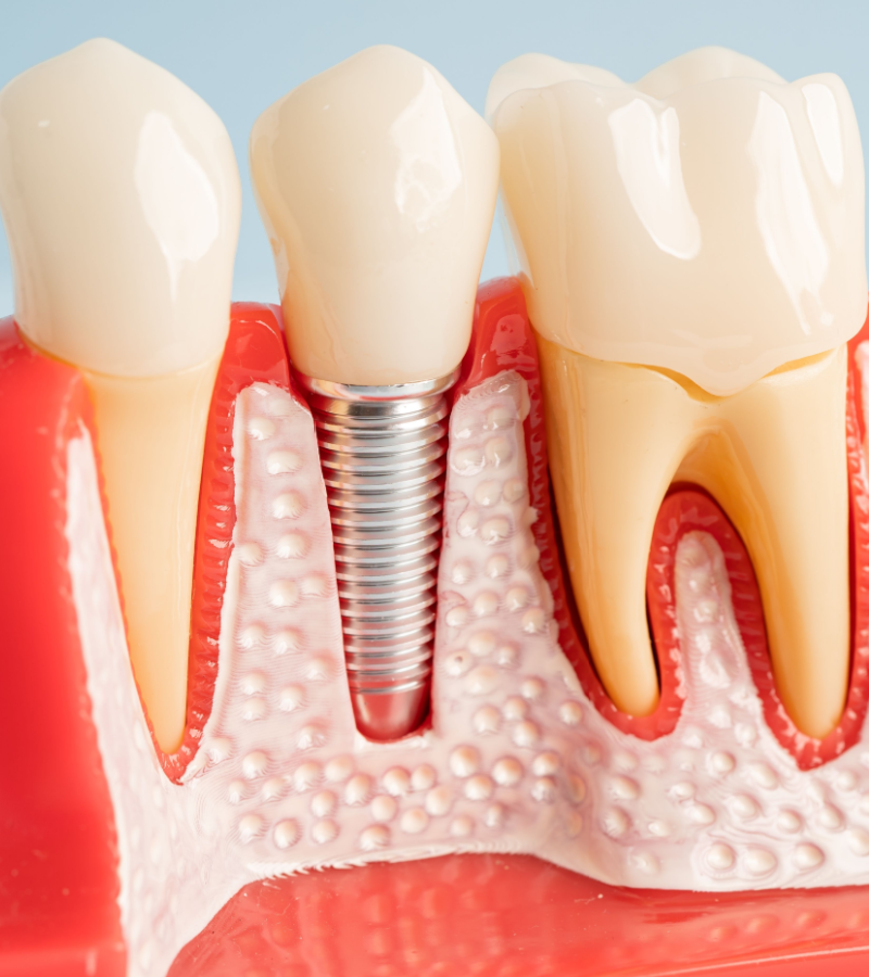 dental implants in burke va