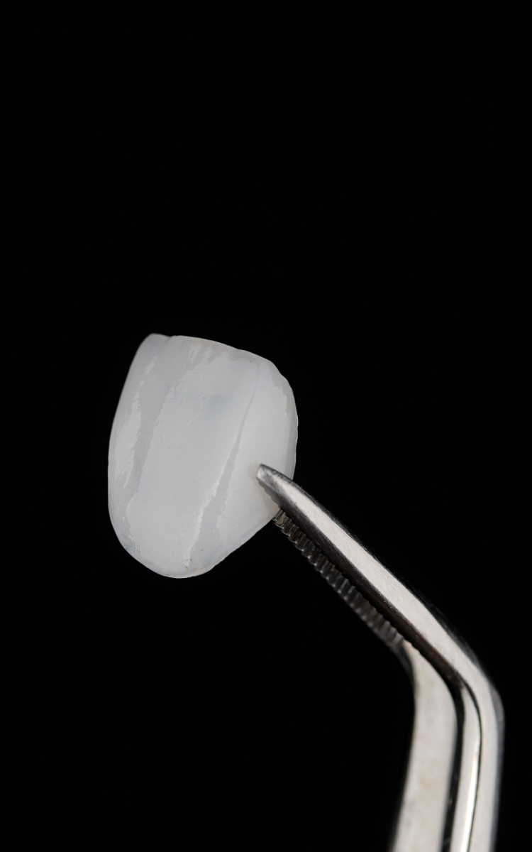 veneers in burke va