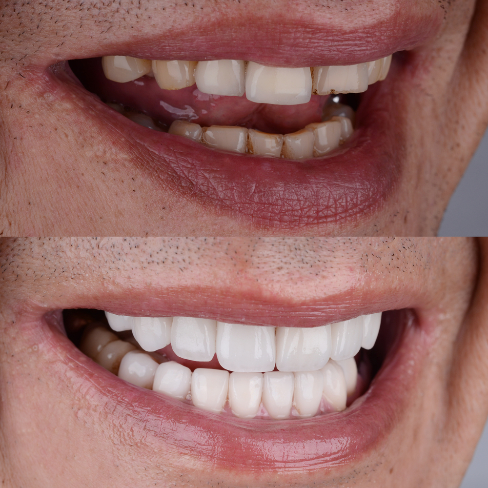 veneers in burke va